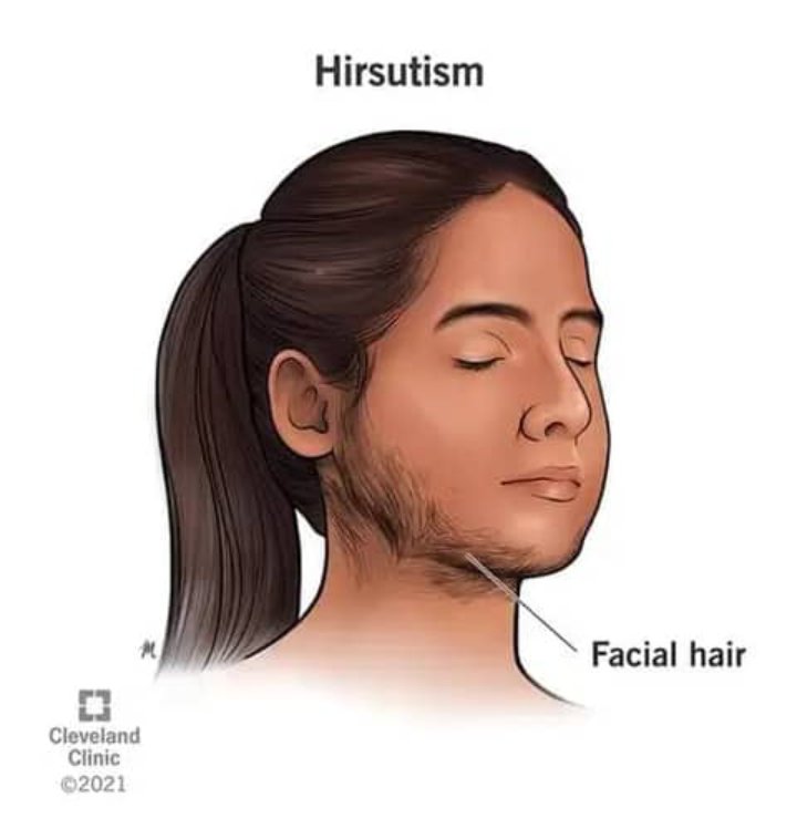 WHAT IS HIRSUTISM - Nigerian Entertainment News